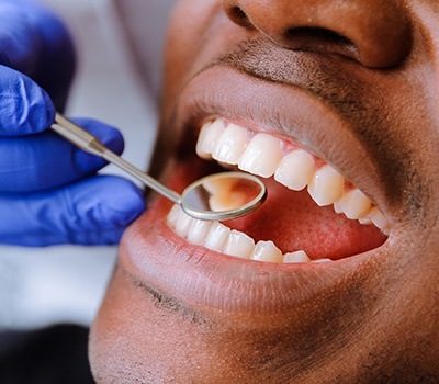 man getting tooth-colored fillings