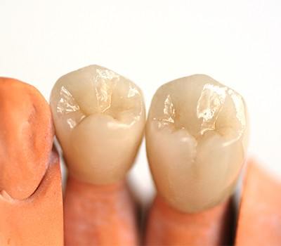 two dental crowns