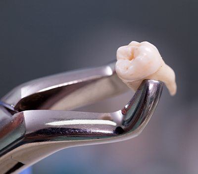 extracted tooth