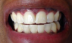 Perfected smile after cosmetic dentistry