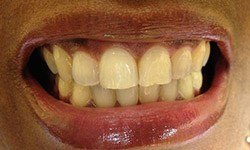 Discolored teeth before cosmetic dentistry