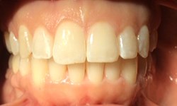 Perfected smile after cosmetic dentistry