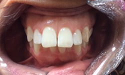 Discolored teeth before cosmetic dentistry