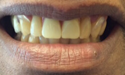 Perfected smile after cosmetic dentistry