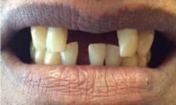 missing teeth before cosmetic dentistry