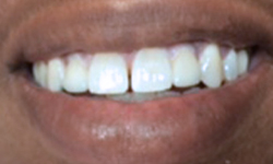 Perfected smile after cosmetic dentistry