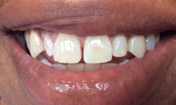 Mialigned discolored teeth