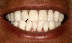Brilliant smile after teeth whitening
