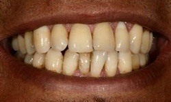 Yellow teeth before teeth whitening