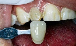Discolored teeth before teeth whitening