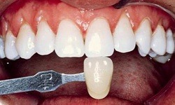 Bright white smile after teeth whitening