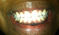 Smile after cosmetic dentistry