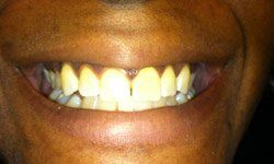 Smile with gaps between teeth