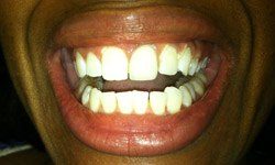 Perfected smile after cosmetic dentistry