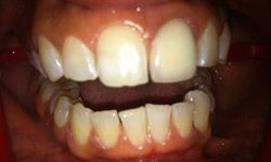 Damaged teeth before cosmetic dentistry