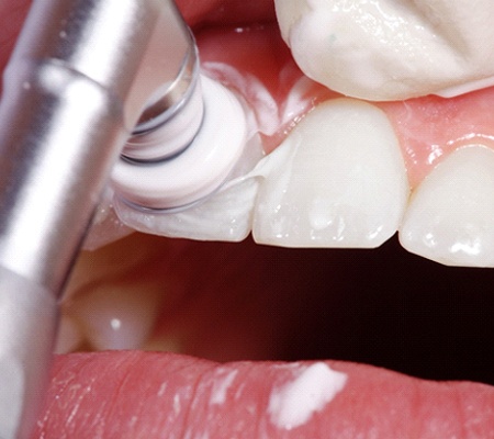 a person getting a dental cleaning