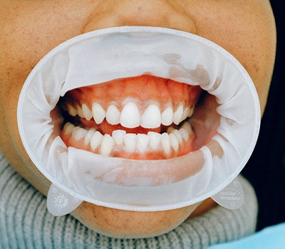 Woman at consultation for crowded teeth