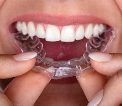 Woman inserting Invisalign clear aligner