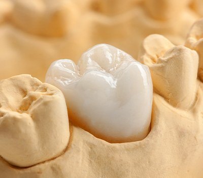 tooth-colored dental crown