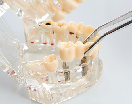 Model of a mouth with two dental implants replacing three teeth