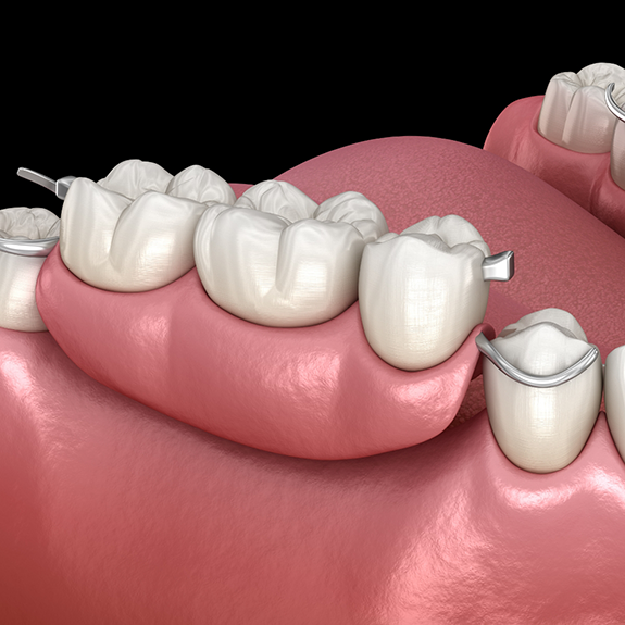 Illustration of a partial denture replacing several missing teeth