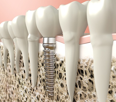 Digital illustration of a dental implant