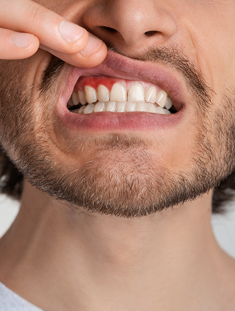 Man pointing to his red gums before gum disease treatment in Bowie