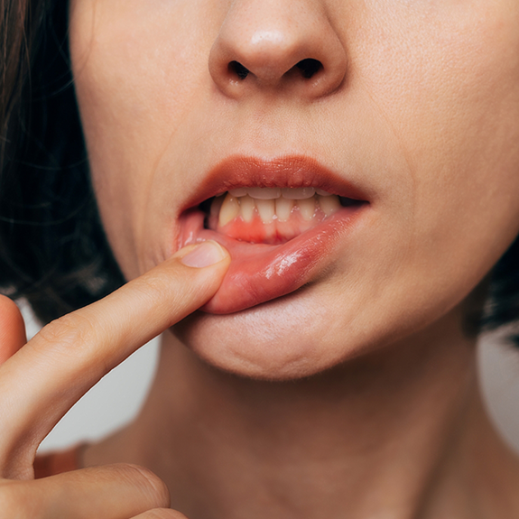 Close up of a woman pointing to her red gums