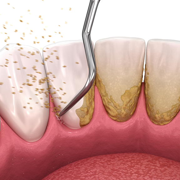 Illustration of a dental scaler clearing plaque from the teeth and gums