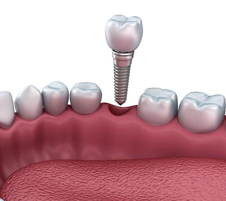 Diagram of a dental implant in Bowie hovering over a mouth.