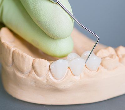 dental bridge