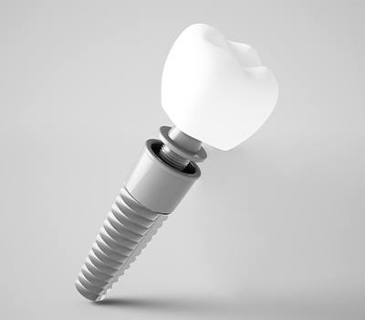 dental implant illustration