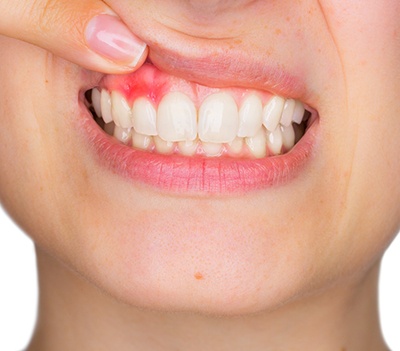 Closeup of woman pointing to red gums