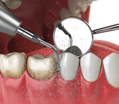 Animated rendering of periodontal therapy