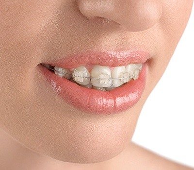 teeth with six month smiles braces