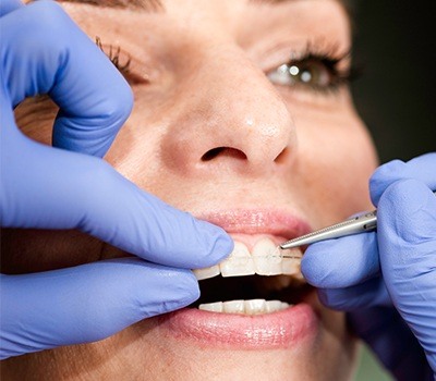 dentist placing on six month smiles