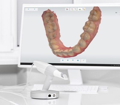 Digital dental impressions on computer screen