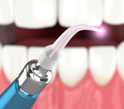 Illustration of laser in foreground, teeth in background