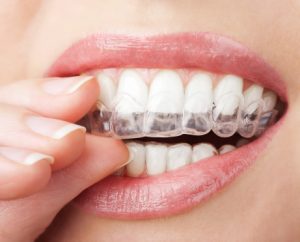 Woman using Invisalign bowie residents rely on