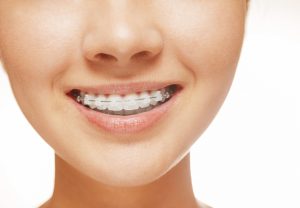 Six Month Smiles in Bowie fixes crooked or gapped teeth. Ambiance Dental Spa uses clear brackets and tooth-colored wires for quick smile improvement. 