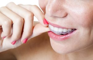 Invisalign aligners in Bowie are easy to clean.