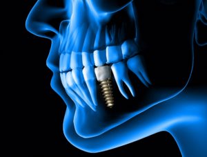 digital dental implant