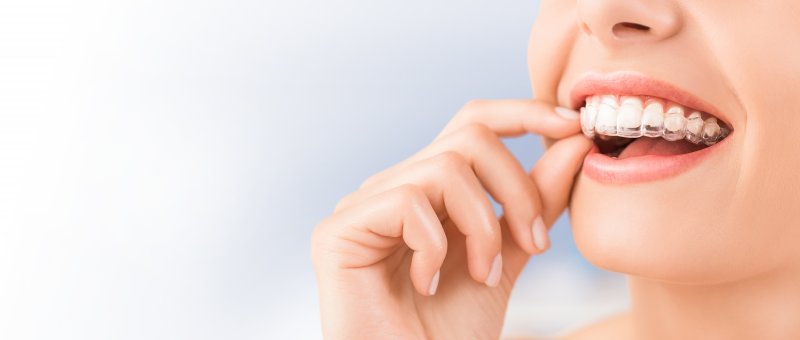 a young woman inserting an Invisalign aligner into the top arch of her mouth