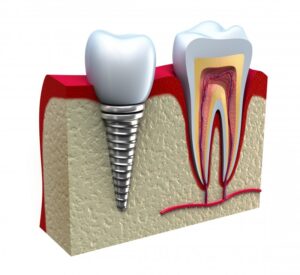 Rendering showing dental implant in mouth.