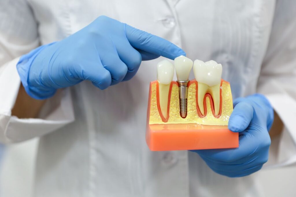 A dentist showing a dental implant model to a patient